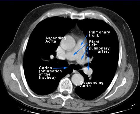 longhili|Imaging of Hila and Pulmonary Vessels 